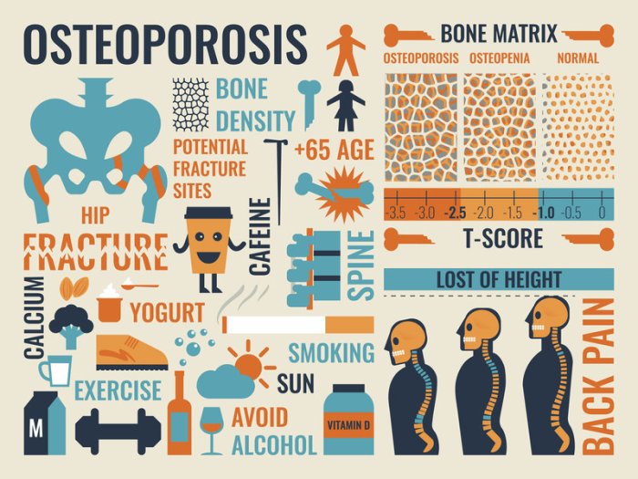 Prevention And Management Of Osteoporosis
